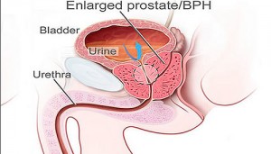 prostate cancer